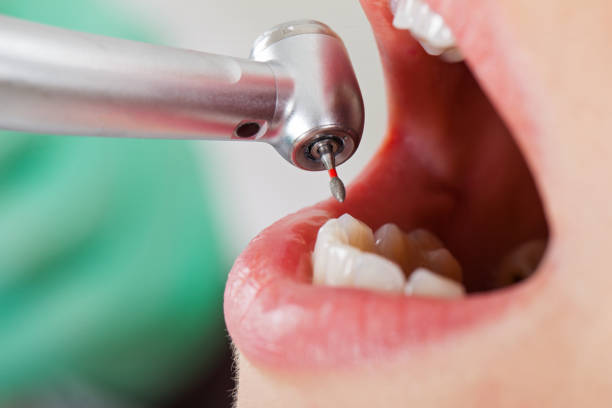 Best Emergency Dentist for Knocked-Out Tooth in Nutter Fort, WV